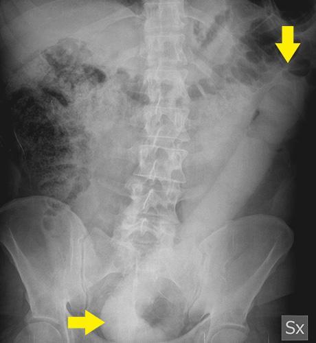 Homem para no hospital com consolo de 58 centímetros no ânus