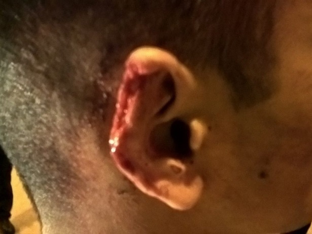 Homem tem orelha parcialmente arrancada em ataque anti-gay em banheiro
